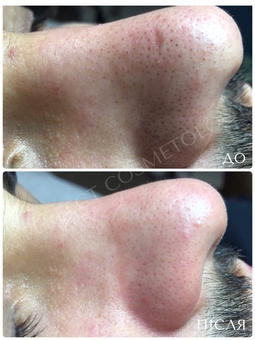 Маски та пілінги у «Perfect Cosmetology» у Києві. Записуйся по знижці.